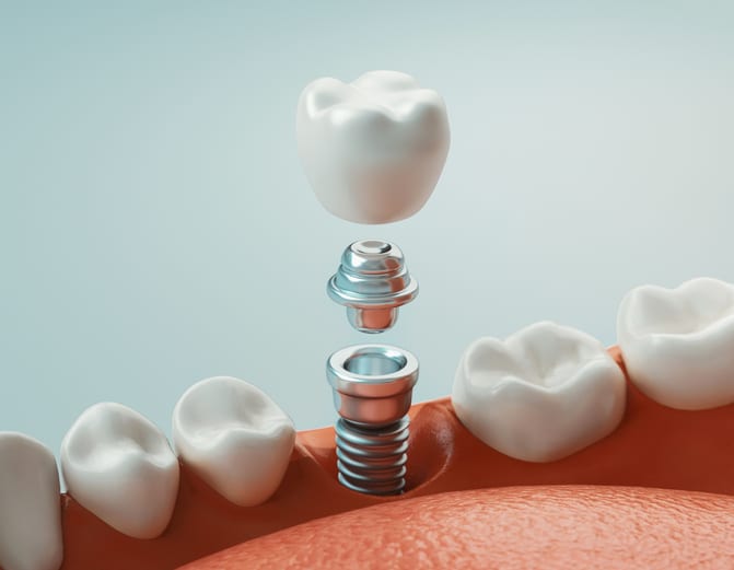 Dental Implants in Frederick, Maryland