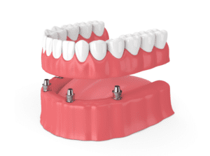 multiple dental implants frederick md