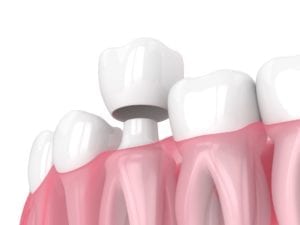 How Dental Crowns are Used