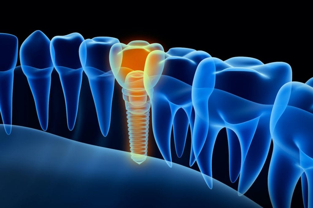 dental implants and jawbone regeneration in Frederick Maryland