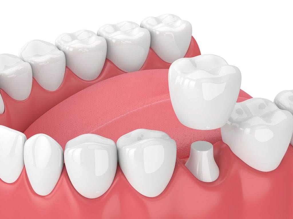 dental crown procedure in Frederick Maryland