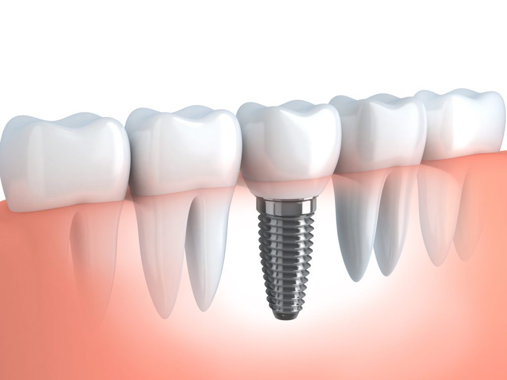 single dental implant frederick md