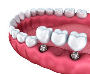 multiple dental implants frederick md