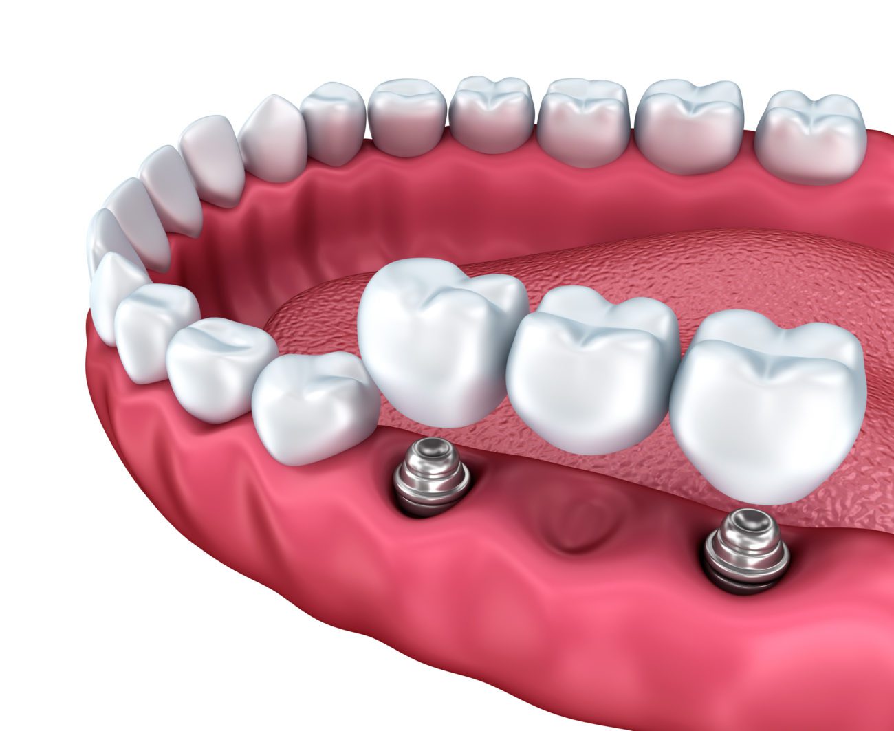 Multiple Dental Implants Frederick MD Teeth Implants