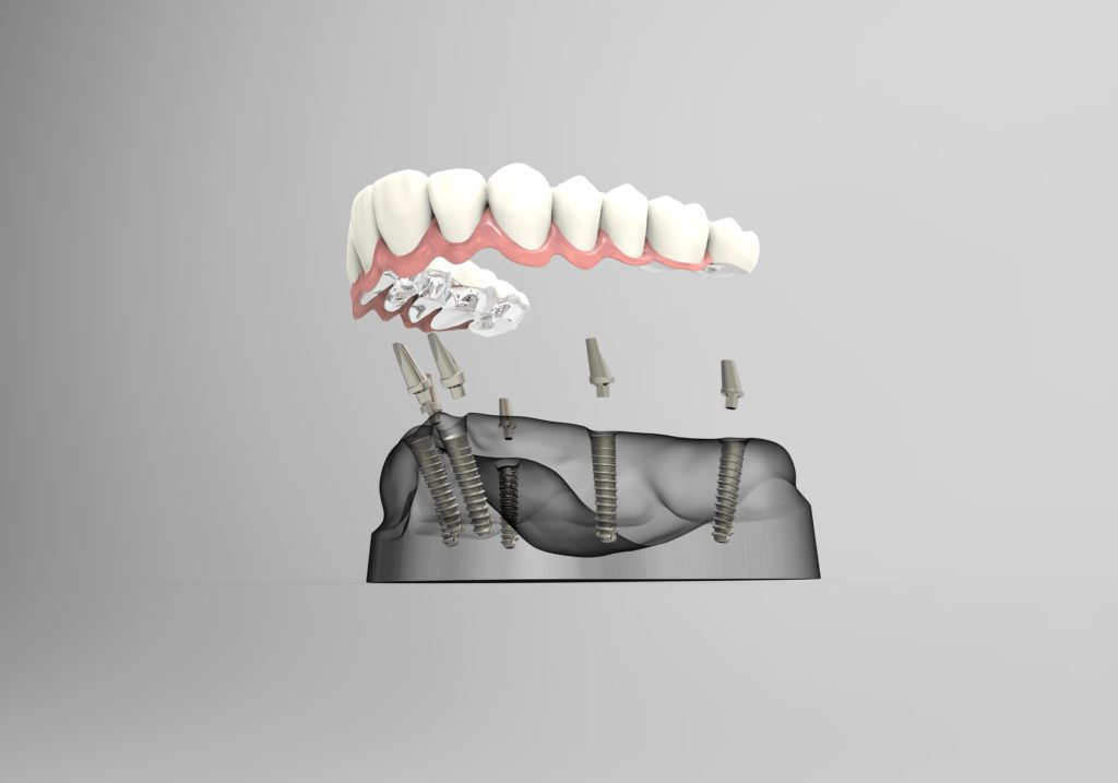 The Dental Implant Process in Frederick MD