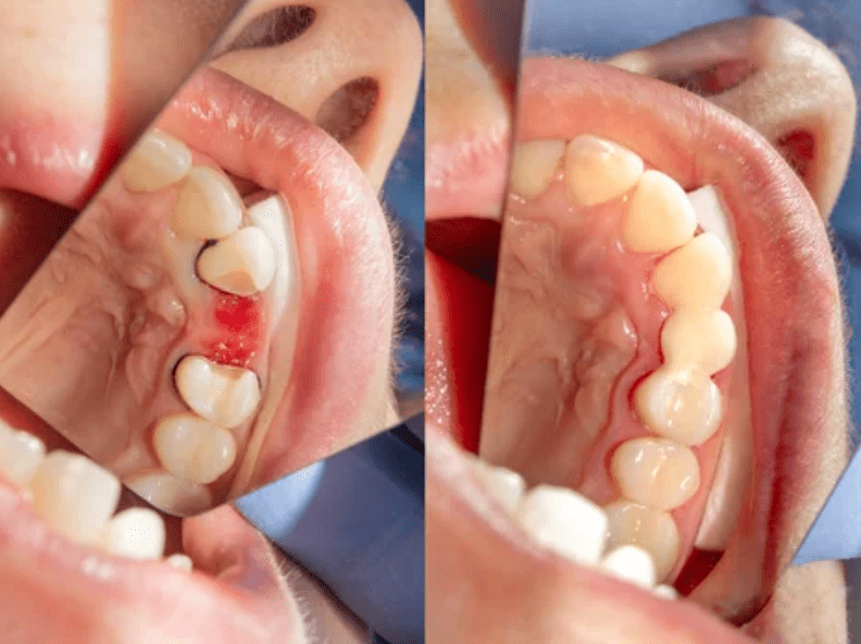 Side-by-side comparison before and after installation of dental bridge missing teeth dental bridges dentist in Frederick Maryland