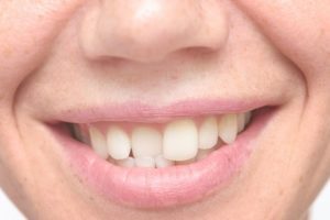 Close up shot of crooked teeth cosmetic dentistry dental concerns dentist in Frederick Maryland