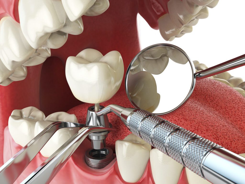 DENTAL IMPLANTS in FREDERICK, MD, can help restore missing teeth in your smile
