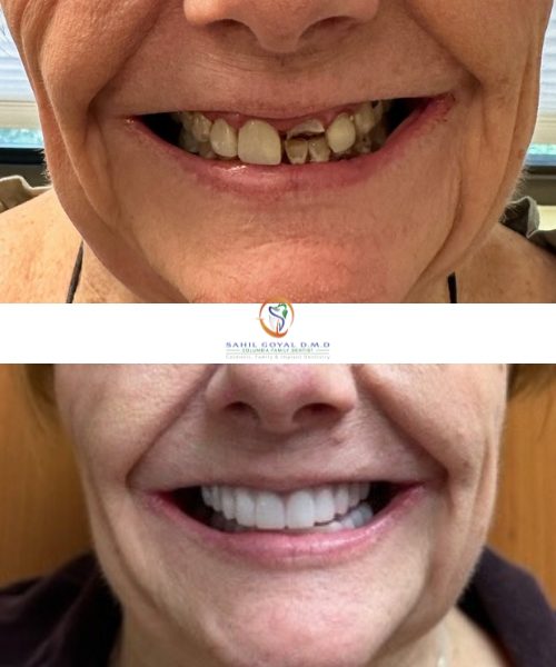 Dental patient before and after dental crowns in Frederick