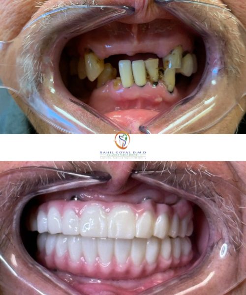 Dental patient before and after modern implant-supported dentures