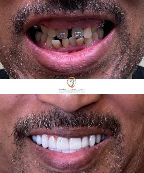 Dental Patient before and after cosmetic dental care