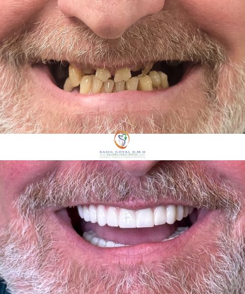 Dental patient before and after removing and replacing teeth