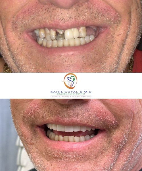 Dental patient before and after restorative dentistry