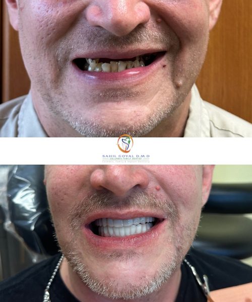 Dental patient before and after restorative dental treatments in Frederick