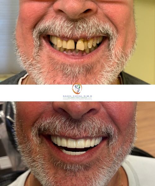 Dental patient before and after porcelain veneers