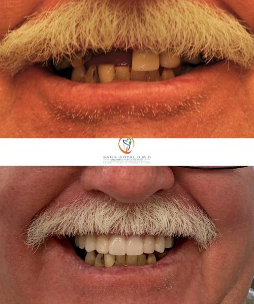 Dental patient before and after dental bridge in Frederick