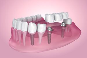 Getting multiple dental implants along with an implant-supported bridge or denture could help restore your smile and bite function