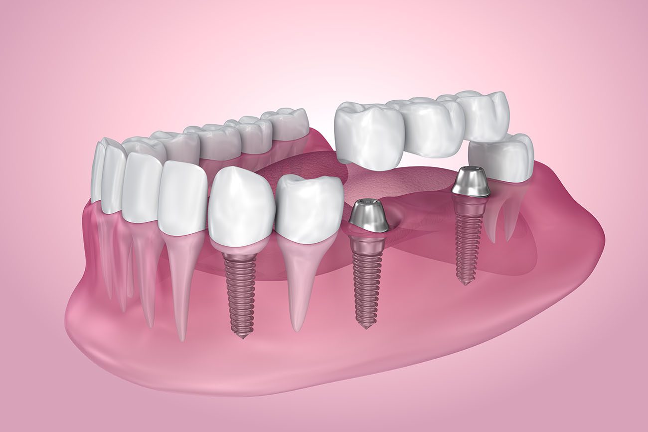 Getting multiple dental implants along with an implant-supported bridge or denture could help restore your smile and bite function