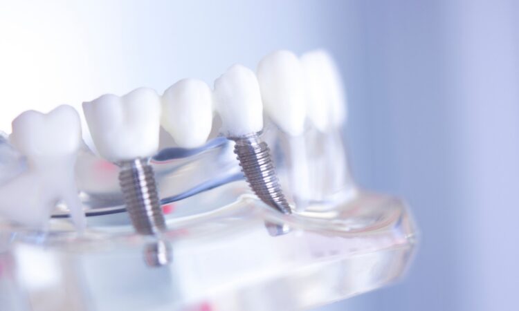 Unlike dentures or bridges, dental implants are designed to mimic the structure of natural teeth, providing both stability and durability.