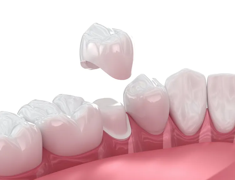 Same-Day Crowns vs. Traditional Crowns in Frederick, MD