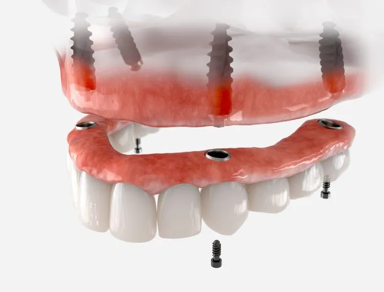 Dental Implants vs. Dentures: How to Choose in Frederick, MD